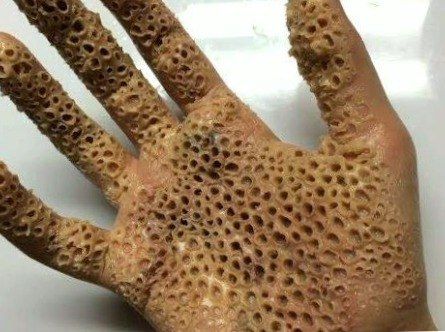 fobia-dermatofobia-tripofobia